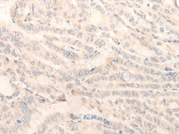 Immunohistochemistry of paraffin-embedded Human thyroid cancer tissue  using INPP1 Polyclonal Antibody at dilution of 1:35(?200)