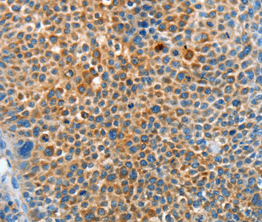 Immunohistochemistry of paraffin-embedded Human liver cancer tissue using SERPINF2 Polyclonal Antibody at dilution 1:50