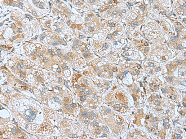 Immunohistochemistry of paraffin-embedded Human liver cancer tissue  using DHX58 Polyclonal Antibody at dilution of 1:60(?200)