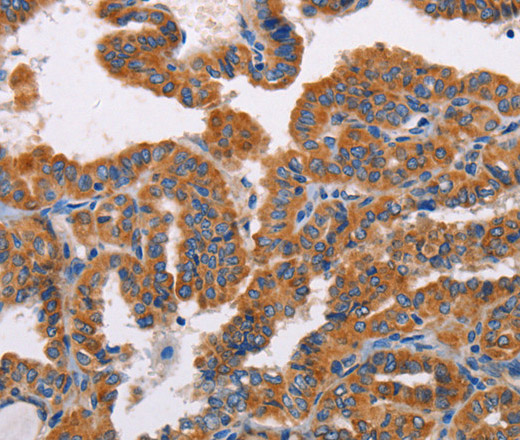 Immunohistochemistry of paraffin-embedded Human thyroid cancer tissue using ALG9 Polyclonal Antibody at dilution 1:30