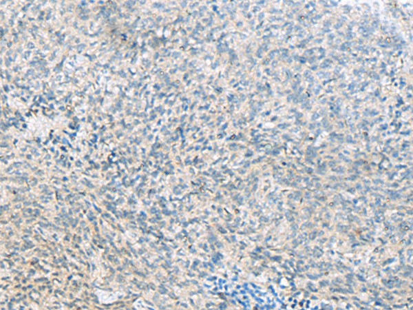 Immunohistochemistry of paraffin-embedded Human cervical cancer tissue  using C1orf112 Polyclonal Antibody at dilution of 1:55(?200)