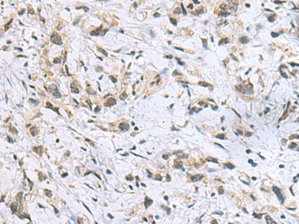 Immunohistochemistry of paraffin-embedded Human gastric cancer tissue  using ITGB1BP1 Polyclonal Antibody at dilution of 1:60(?200)