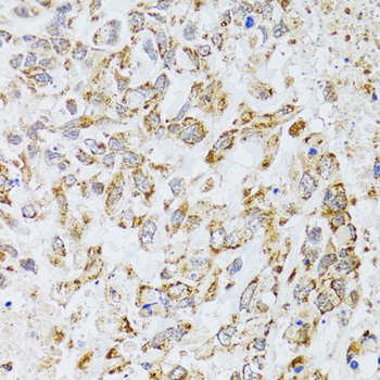 Immunohistochemistry of paraffin-embedded Human lung cancer using AIFM3 Polyclonal Antibody at dilution of 1:100 (40x lens).