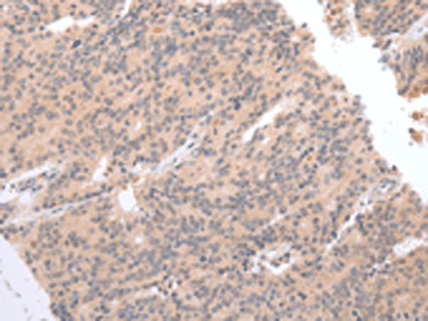 Immunohistochemistry of paraffin-embedded Human prost at e cancer tissue  using DEFB112 Polyclonal Antibody at dilution of 1:40(?200)