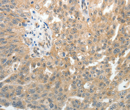 Immunohistochemistry of paraffin-embedded Human ovarian cancer tissue using E-Selectin Polyclonal Antibody at dilution of 1:40