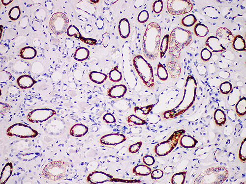 Immunohistochemistry of paraffinembedded Human renal clear cell carcinoma tissue with Kidney-specific cadherin(KSP-Cad) Monoclonal Antibody(Antigen repaired by EDTA).