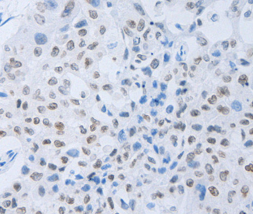 Immunohistochemistry of paraffin-embedded Human lung cancer tissue using c-Fms Polyclonal Antibody at dilution 1:45