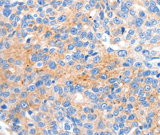 Immunohistochemistry of paraffin-embedded Human ovarian cancer tissue using HCN2 Polyclonal Antibody at dilution 1:80