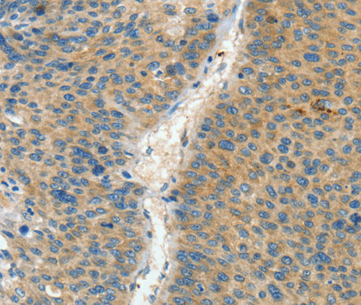 Immunohistochemistry of paraffin-embedded Human liver cancer using ASPA Polyclonal Antibody at dilution of 1:60