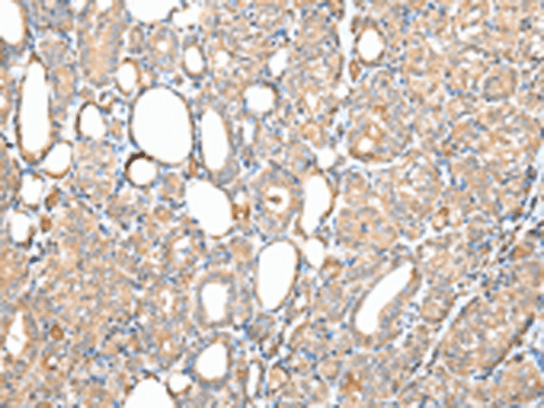 Immunohistochemistry of paraffin-embedded Human thyroid cancer tissue  using DPH7 Polyclonal Antibody at dilution of 1:40(?200)