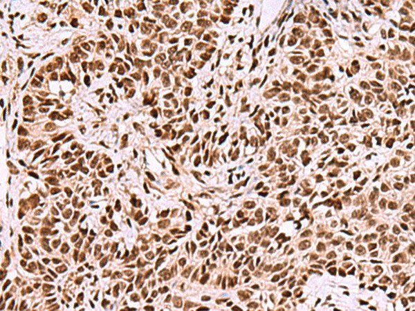 Immunohistochemistry of paraffin-embedded Human ovarian cancer tissue  using FOXK2 Polyclonal Antibody at dilution of 1:50(?200)