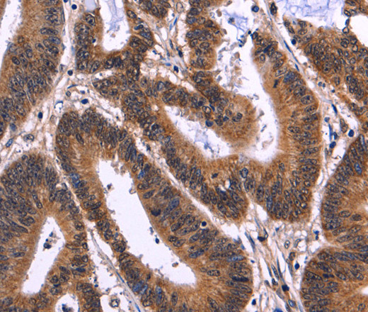 Immunohistochemistry of paraffin-embedded Human colon cancer tissue using MSH4 Polyclonal Antibody at dilution 1:50
