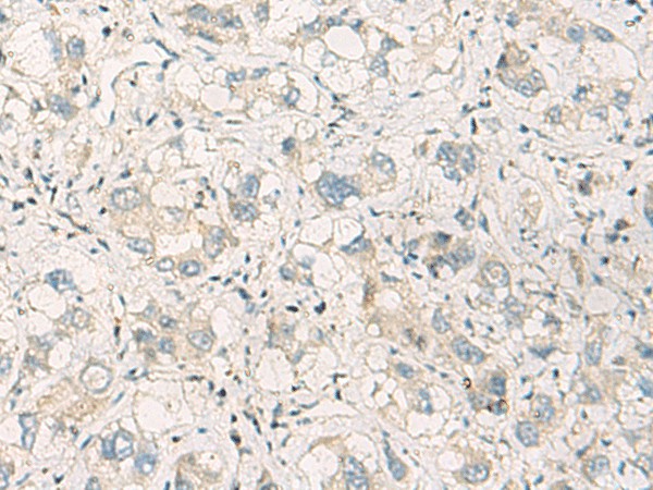 Immunohistochemistry of paraffin-embedded Human liver cancer tissue  using SPSB2 Polyclonal Antibody at dilution of 1:70(?200)