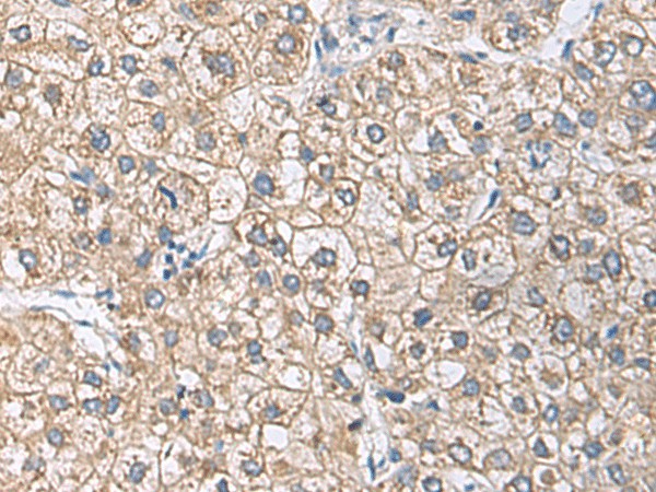 Immunohistochemistry of paraffin-embedded Human liver cancer tissue  using UBE2N Polyclonal Antibody at dilution of 1:55(?200)