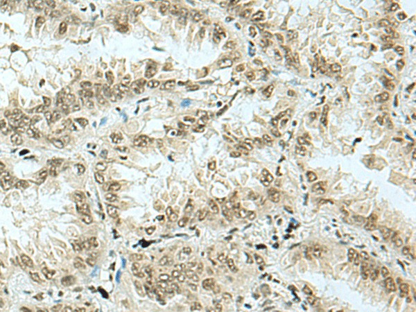 Immunohistochemistry of paraffin-embedded Human lung cancer tissue  using HAS1 Polyclonal Antibody at dilution of 1:70(?200)