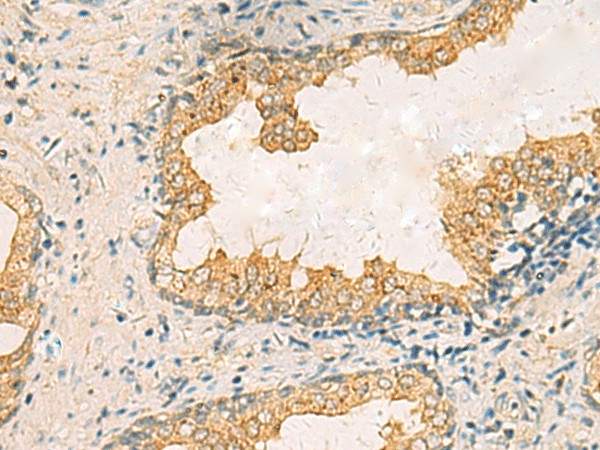 Immunohistochemistry of paraffin-embedded Human prost ate cancer tissue  using HORMAD2 Polyclonal Antibody at dilution of 1:35(?200)