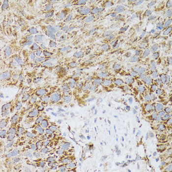 Immunohistochemistry of paraffin-embedded Human lung cancer using PDYN Polyclonal Antibody at dilution of 1:100 (40x lens).