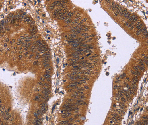 Immunohistochemistry of paraffin-embedded Human colon cancer tissue using DCBLD2 Polyclonal Antibody at dilution 1:50