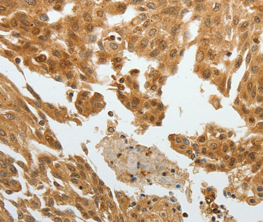 Immunohistochemistry of paraffin-embedded Human cervical cancer tissue using RETNLB Polyclonal Antibody at dilution 1:40