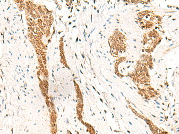 Immunohistochemistry of paraffin-embedded Human esophagus cancer tissue  using HOXC13 Polyclonal Antibody at dilution of 1:60(?200)