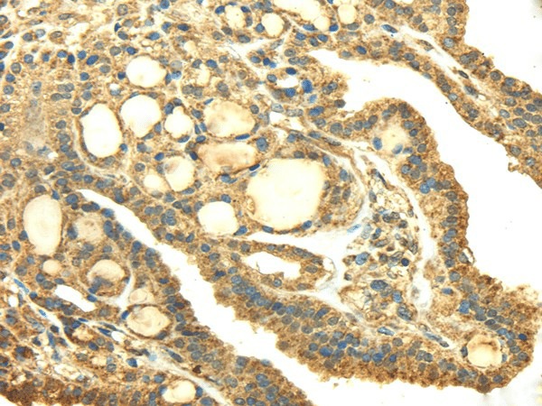 Immunohistochemistry of paraffin-embedded Human thyroid cancer using SDHA Polyclonal Antibody at dilution of  1/40