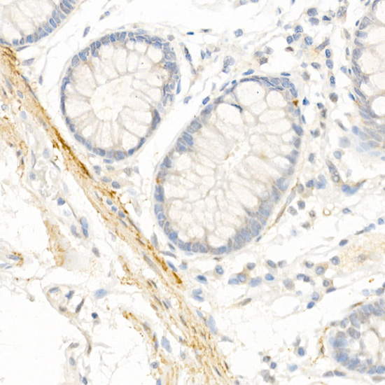 Immunohistochemistry of paraffin-embedded human colon using Transgelin (TAGLN) Polyclonal antibody at dilution of 1:25 (40x lens).Perform high pressure antigen retrieval with 10 mM citrate buffer pH 6.0 before commencing with IHC staining protocol.