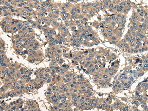 Immunohistochemistry of paraffin-embedded Human liver cancer tissue  using CORO1B Polyclonal Antibody at dilution of 1:40(?200)