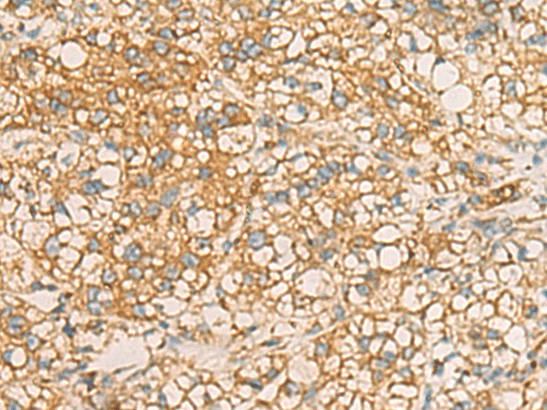 Immunohistochemistry of paraffin-embedded Human liver cancer tissue  using AIMP1 Polyclonal Antibody at dilution of 1:40(?200)