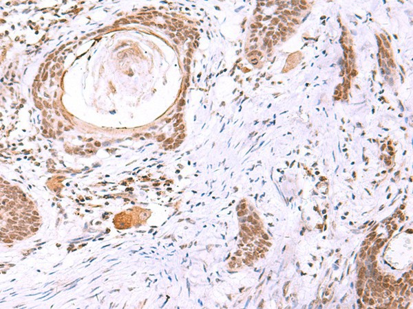 Immunohistochemistry of paraffin-embedded Human esophagus cancer tissue  using ITPKC Polyclonal Antibody at dilution of 1:30(?200)