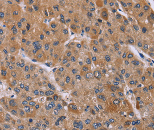 Immunohistochemistry of paraffin-embedded Human liver cancer using Cyclophilin F Polyclonal Antibody at dilution of 1:45