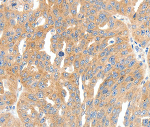 Immunohistochemistry of paraffin-embedded Human breast cancer tissue using COL4A1 Polyclonal Antibody at dilution 1:30