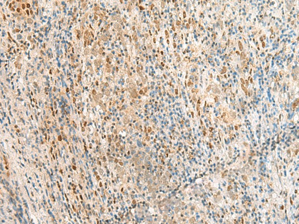 Immunohistochemistry of paraffin-embedded Human cervical cancer tissue  using RPS27A Polyclonal Antibody at dilution of 1:35(?200)