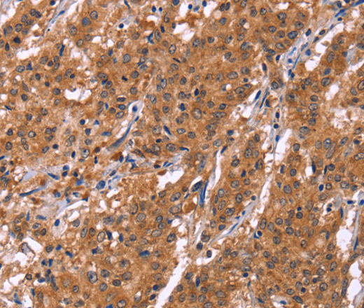 Immunohistochemistry of paraffin-embedded Human gastric cancer tissue using HLTF Polyclonal Antibody at dilution 1:30