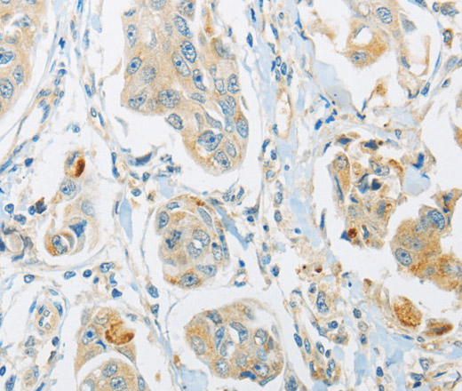 Immunohistochemistry of paraffin-embedded Human breast cancer tissue using ARHGEF10 Polyclonal Antibody at dilution 1:45