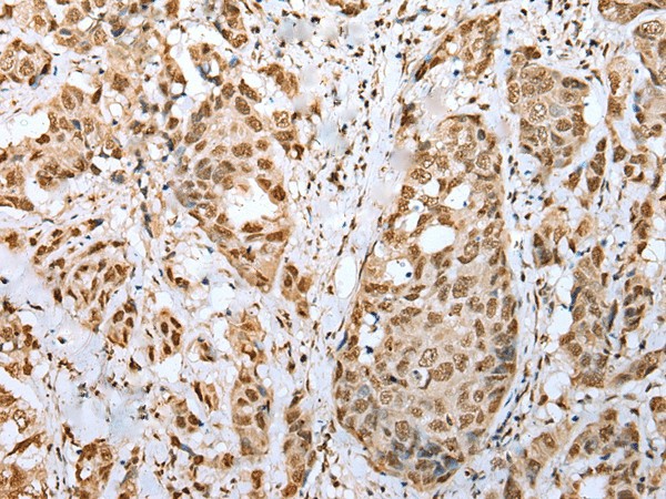 Immunohistochemistry of paraffin-embedded Human breast cancer tissue  using ZNF486 Polyclonal Antibody at dilution of 1:50(?200)