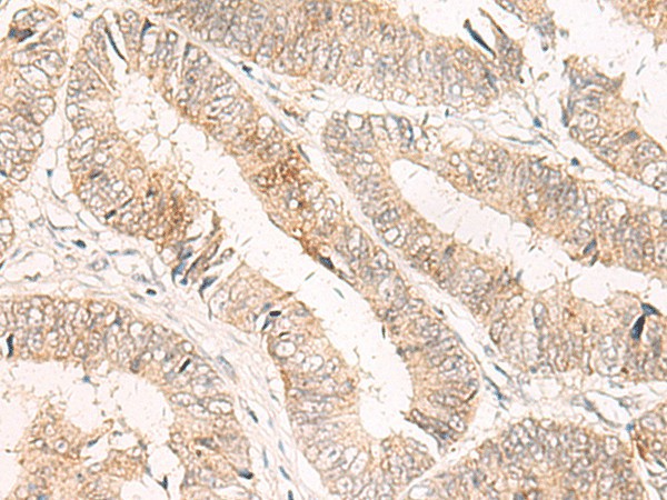 Immunohistochemistry of paraffin-embedded Human colorectal cancer tissue  using TRAPPC1 Polyclonal Antibody at dilution of 1:50(?200)