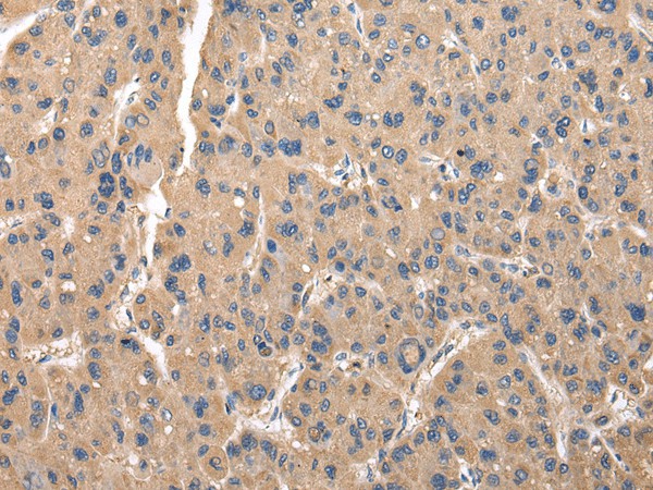 Immunohistochemistry of paraffin-embedded Human thyroid cancer tissue  using ZFAND5 Polyclonal Antibody at dilution of 1:35(?200)