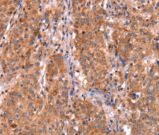 Immunohistochemistry of paraffin-embedded Human gasrtic cancer tissue using ABI1 Polyclonal Antibody at dilution 1:40