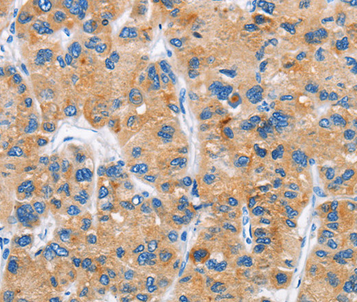 Immunohistochemistry of paraffin-embedded Human liver cancer tissue using DKK2 Polyclonal Antibody at dilution 1:60