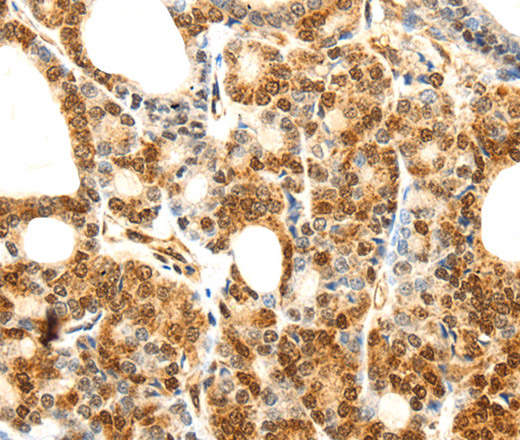 Immunohistochemistry of paraffin-embedded Human thyroid cancer using Otocadherin Polyclonal Antibody at dilution of 1:80