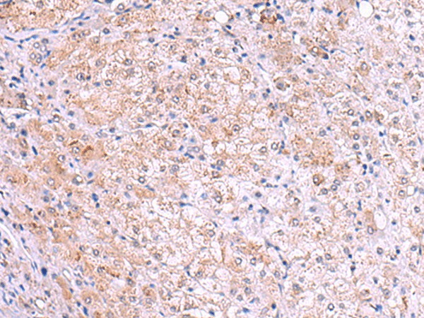 Immunohistochemistry of paraffin-embedded Human liver cancer tissue  using KIR3DL1 Polyclonal Antibody at dilution of 1:105(?200)