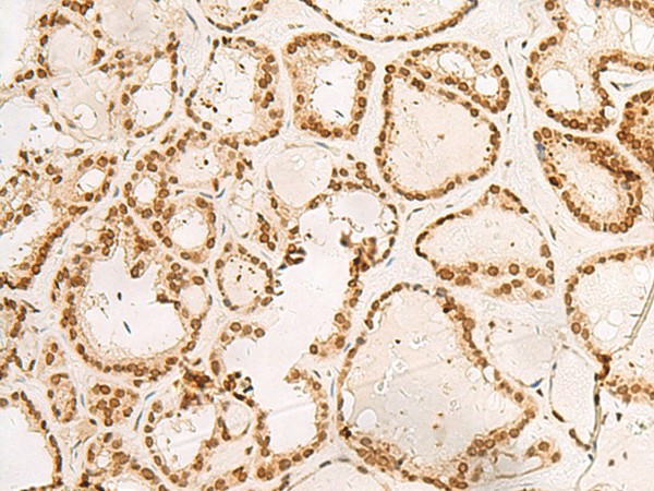 Immunohistochemistry of paraffin-embedded Human thyroid cancer tissue  using POM121 Polyclonal Antibody at dilution of 1:40(?200)