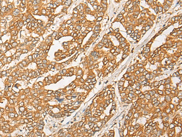 Immunohistochemistry of paraffin-embedded Human liver cancer tissue  using GNB1L Polyclonal Antibody at dilution of 1:35(?200)