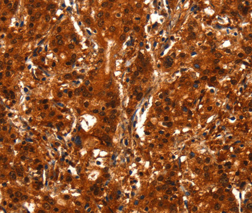 Immunohistochemistry of paraffin-embedded Human gasrtic cancer tissue using BCAS3 Polyclonal Antibody at dilution 1:40