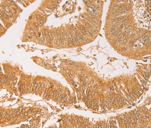 Immunohistochemistry of paraffin-embedded Human colon cancer using AK2 Polyclonal Antibody at dilution of 1:40