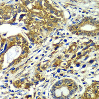 Immunohistochemistry of paraffin-embedded human gastric cancer using CDC16 Polyclonal antibody at dilution of 1:100 (40x lens).Perform microwave antigen retrieval with 10 mM PBS buffer pH 7.2 before commencing with IHC staining protocol.