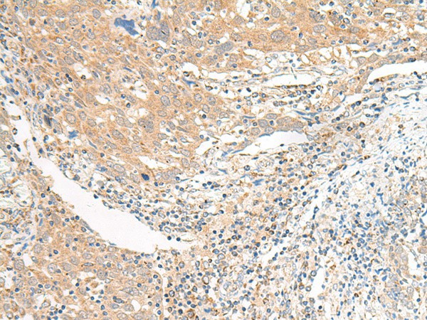 Immunohistochemistry of paraffin-embedded Human cervical cancer tissue  using SLC6A9 Polyclonal Antibody at dilution of 1:25(?200)