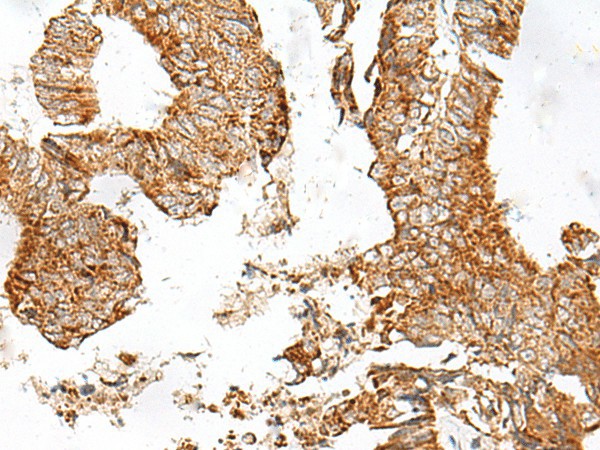 Immunohistochemistry of paraffin-embedded Human colorectal cancer tissue  using GPR119 Polyclonal Antibody at dilution of 1:45(?200)