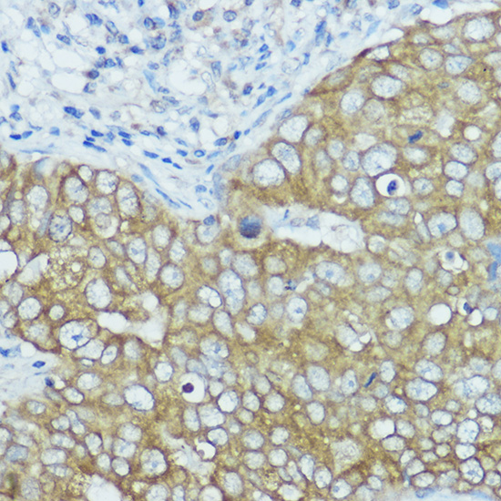 Immunohistochemistry of paraffin-embedded human breast cancer using BSCL2 Polyclonal Antibody at dilution of 1:100 (40x lens).Perform high pressure antigen retrieval with 10 mM citrate buffer pH 6.0 before commencing with IHC staining protocol.