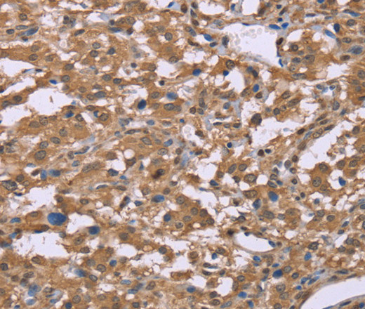 Immunohistochemistry of paraffin-embedded Human liver cancer tissue using IFNA2 Polyclonal Antibody at dilution 1:40